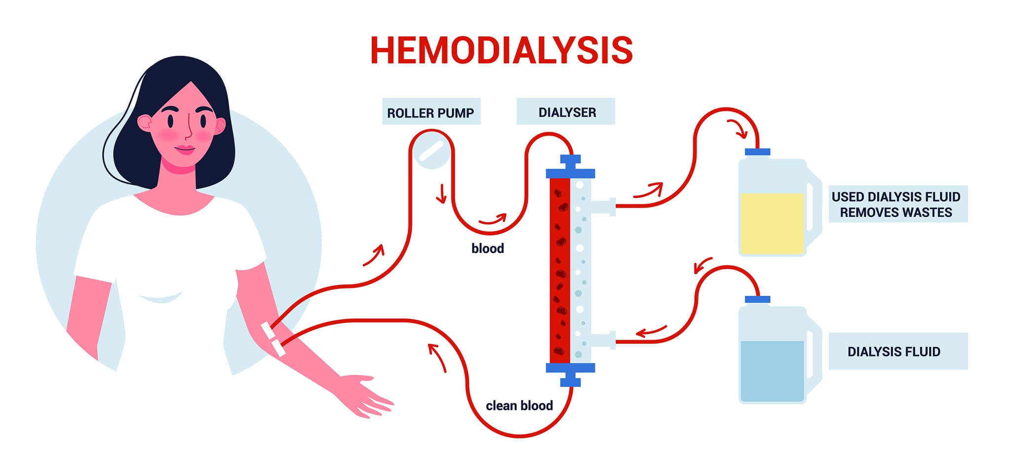 Hemodialisis